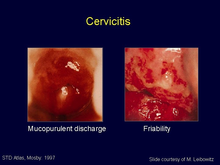 Cervicitis Mucopurulent discharge STD Atlas, Mosby: 1997 Friability Slide courtesy of M. Leibowitz 