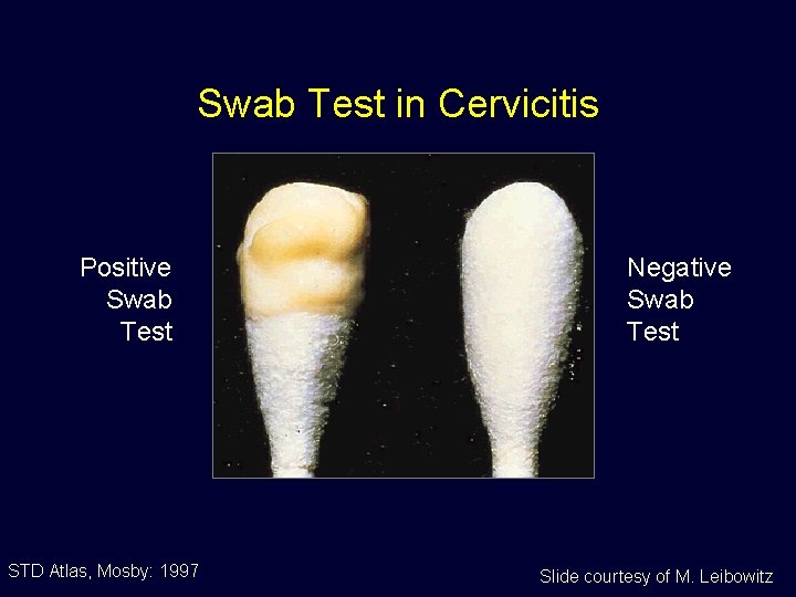 Swab Test in Cervicitis Positive Swab Test STD Atlas, Mosby: 1997 Negative Swab Test