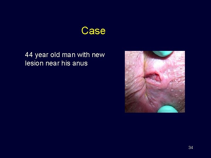 Case 44 year old man with new lesion near his anus 34 