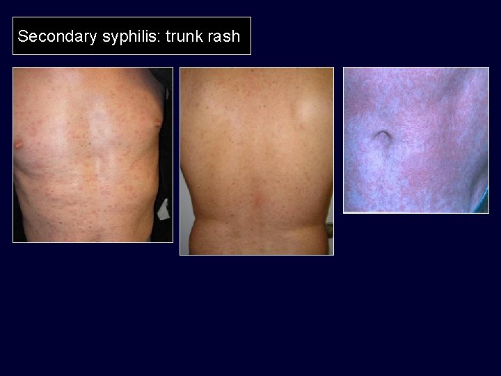 Secondary syphilis: trunk rash 