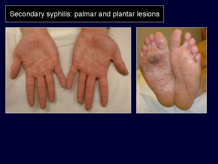 Secondary syphilis: palmar and plantar lesions 