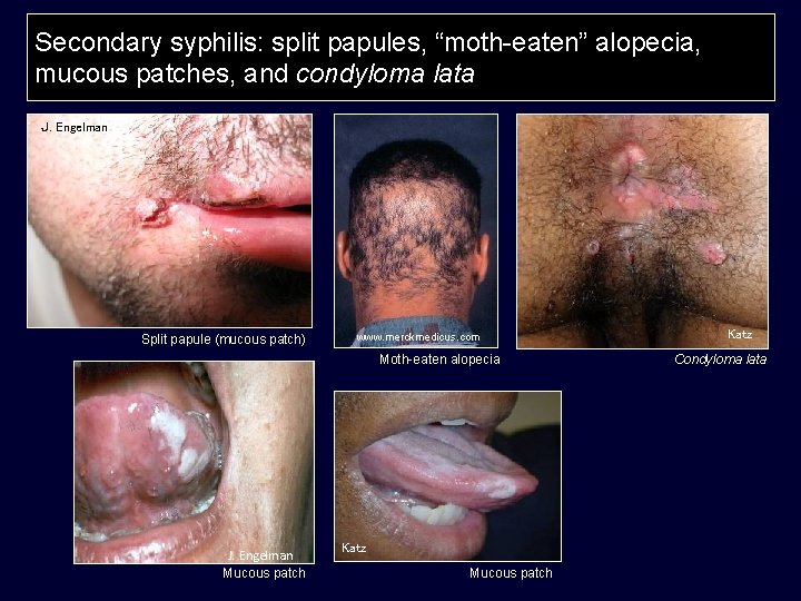 Secondary syphilis: split papules, “moth-eaten” alopecia, mucous patches, and condyloma lata J. Engelman Split