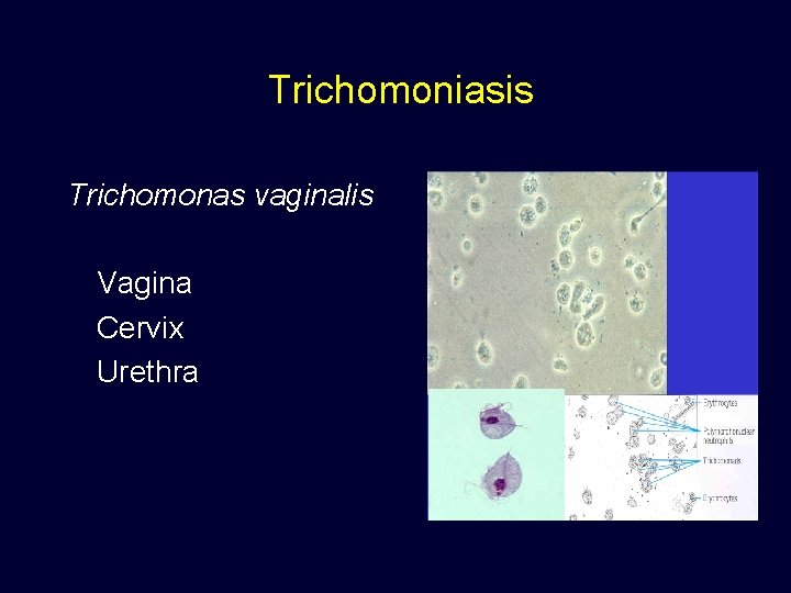 Trichomoniasis Trichomonas vaginalis Vagina Cervix Urethra 
