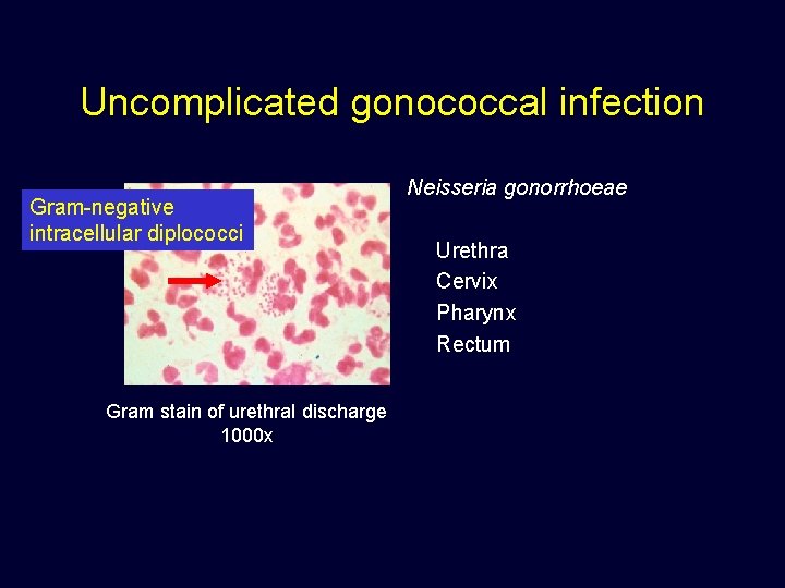 Uncomplicated gonococcal infection Gram-negative intracellular diplococci Gram stain of urethral discharge 1000 x Neisseria