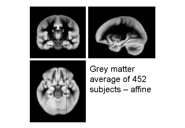 Grey matter average of 452 subjects – affine 