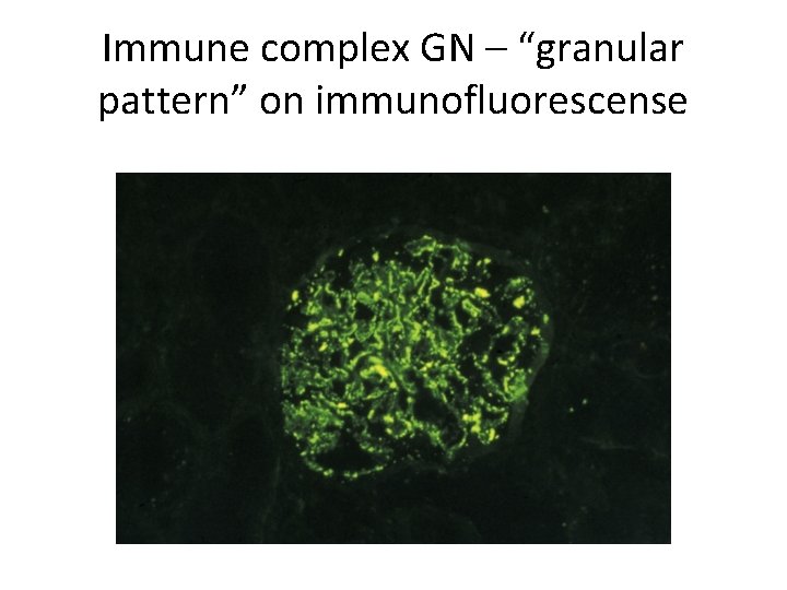 Immune complex GN – “granular pattern” on immunofluorescense 