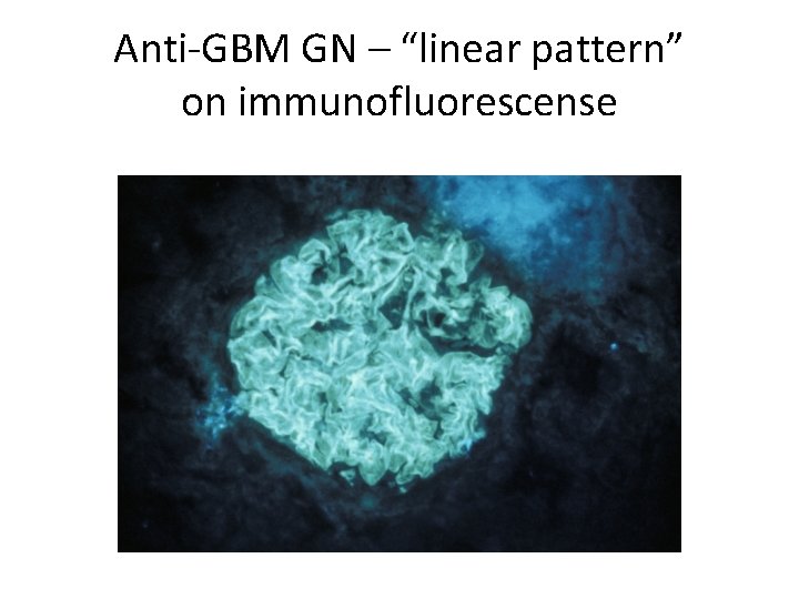 Anti-GBM GN – “linear pattern” on immunofluorescense 