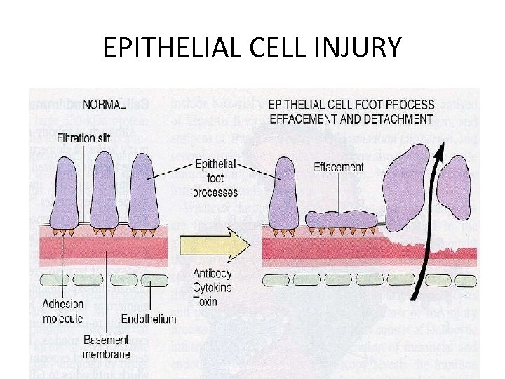 EPITHELIAL CELL INJURY 