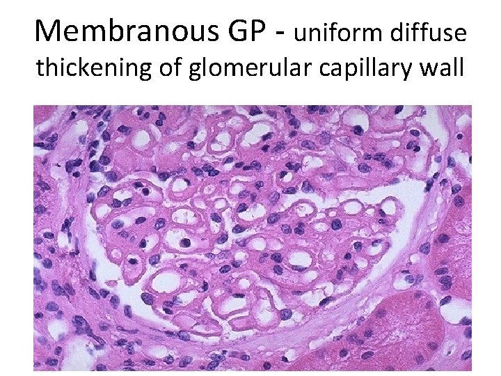 Membranous GP - uniform diffuse thickening of glomerular capillary wall 