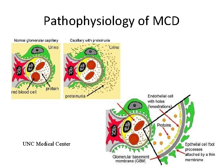 Pathophysiology of MCD UNC Medical Center 
