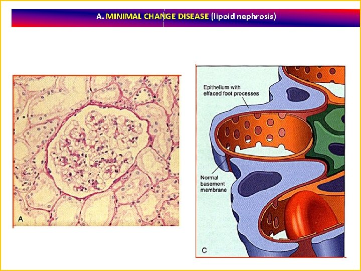 A. MINIMAL CHANGE DISEASE (lipoid nephrosis) 44 