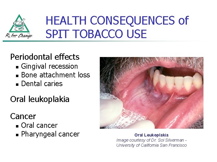 HEALTH CONSEQUENCES of SPIT TOBACCO USE Periodontal effects n n n Gingival recession Bone