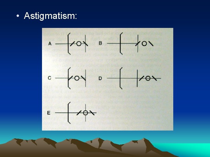  • Astigmatism: 