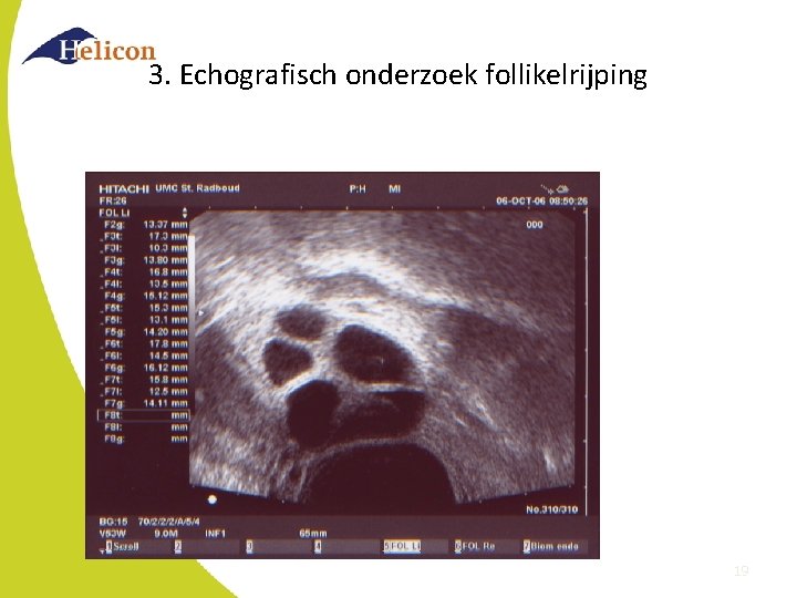 3. Echografisch onderzoek follikelrijping 19 