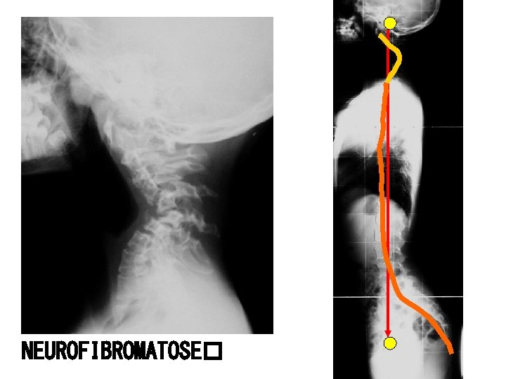 NEUROFIBROMATOSE� 
