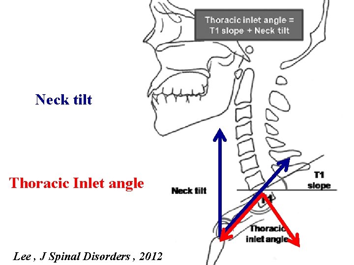 Neck tilt Thoracic Inlet angle Lee , J Spinal Disorders , 2012 