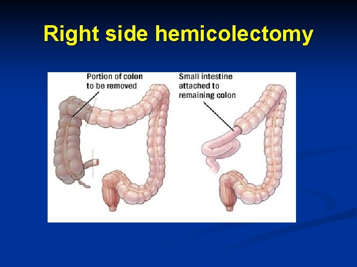 Right side hemicolectomy 