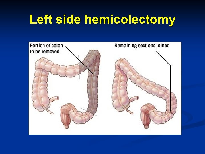 Left side hemicolectomy 