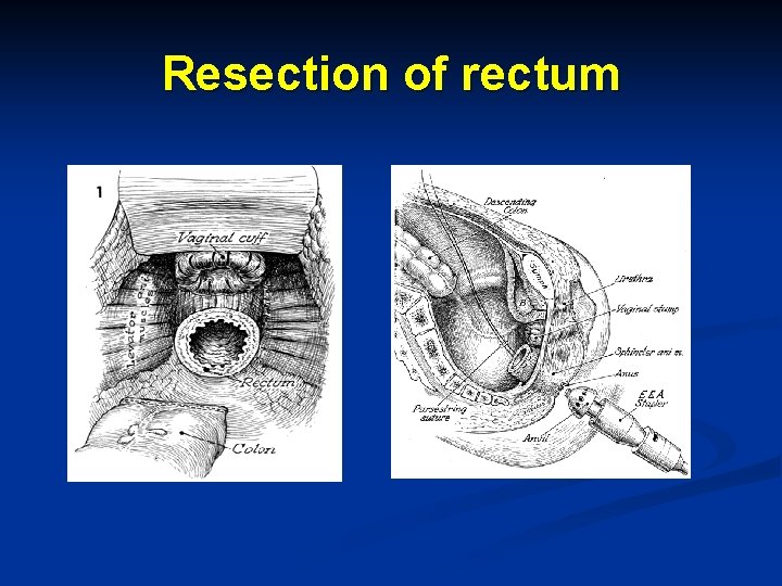 Resection of rectum 