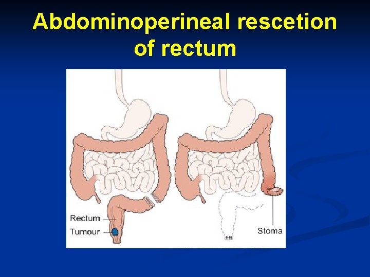 Abdominoperineal rescetion of rectum 