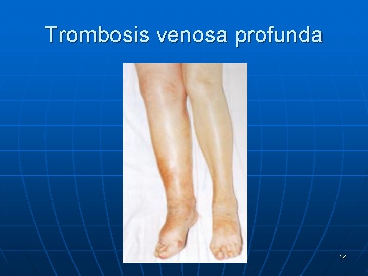 Trombosis venosa profunda 12 
