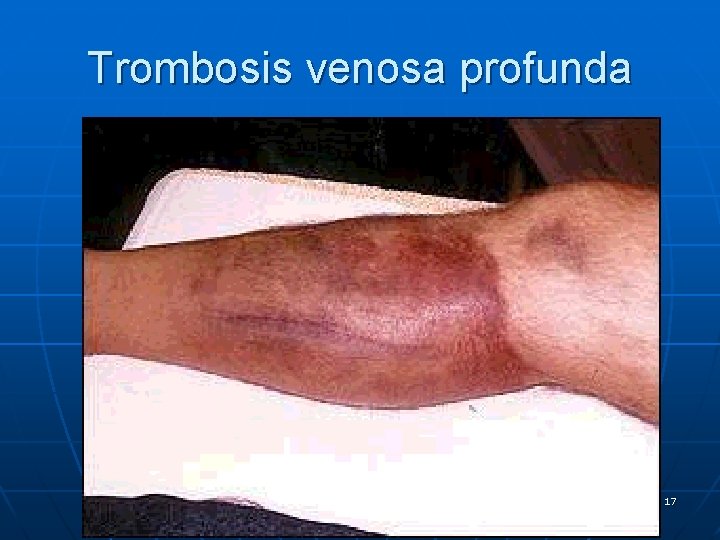 Trombosis venosa profunda 17 