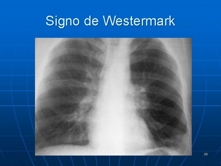 Signo de Westermark 20 
