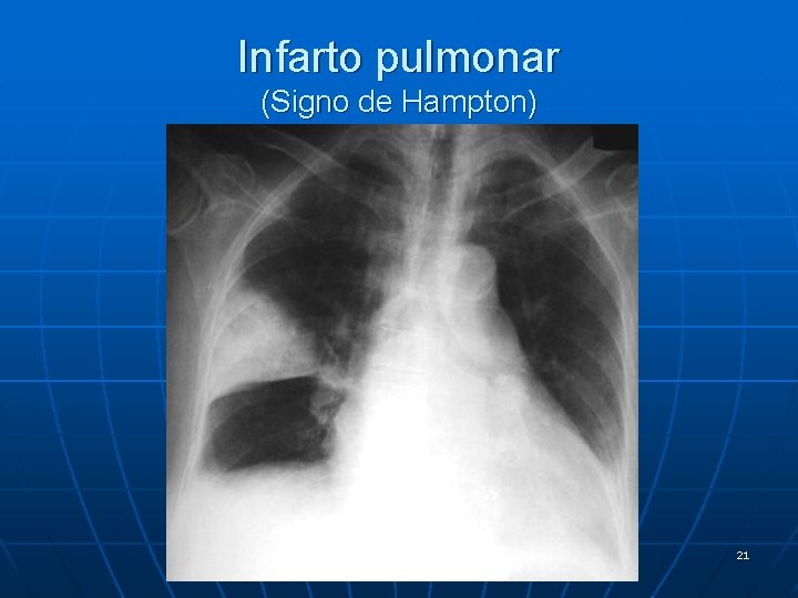 Infarto pulmonar (Signo de Hampton) 21 