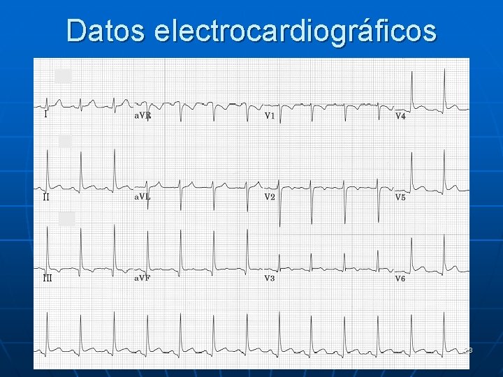 Datos electrocardiográficos I II III 23 