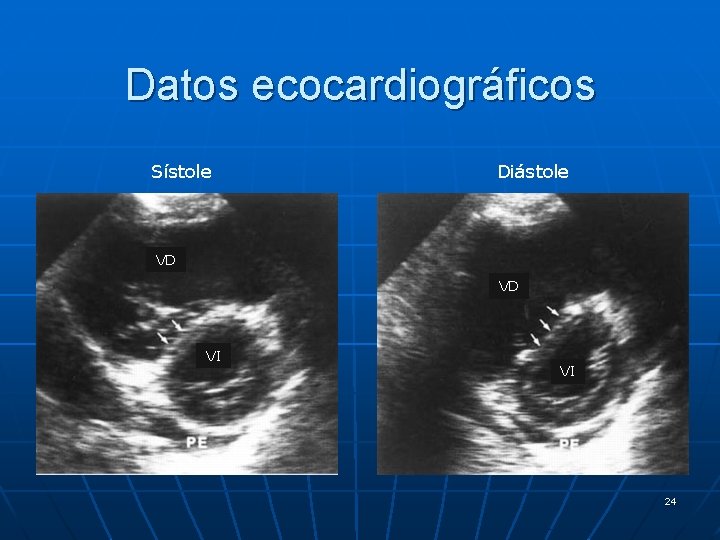 Datos ecocardiográficos Sístole Diástole VD VD VI VI 24 