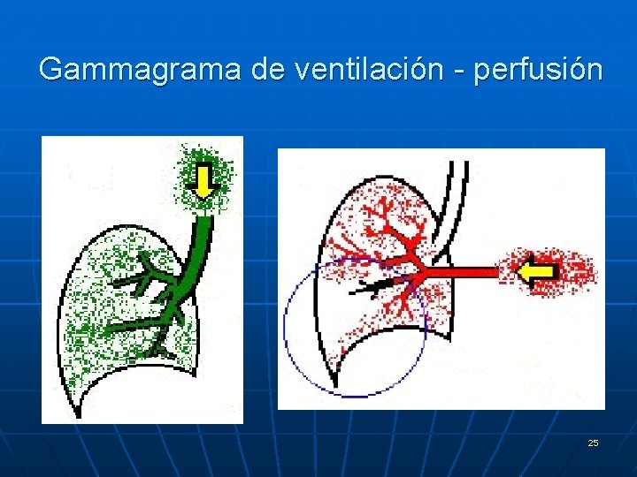 Gammagrama de ventilación - perfusión 25 
