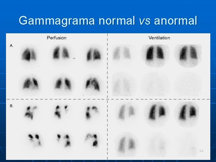 Gammagrama normal vs anormal 26 