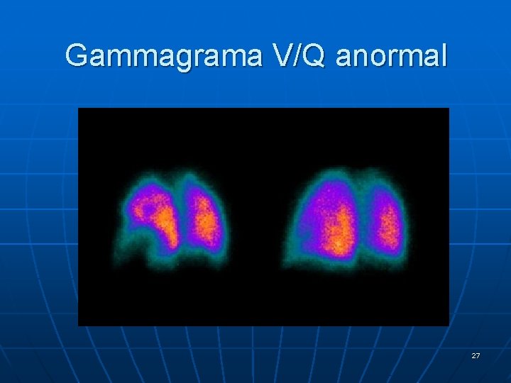 Gammagrama V/Q anormal 27 