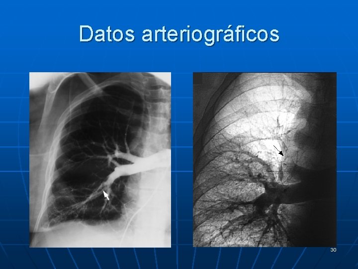 Datos arteriográficos 30 
