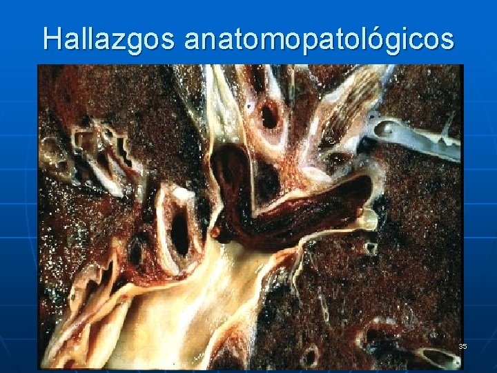 Hallazgos anatomopatológicos 35 