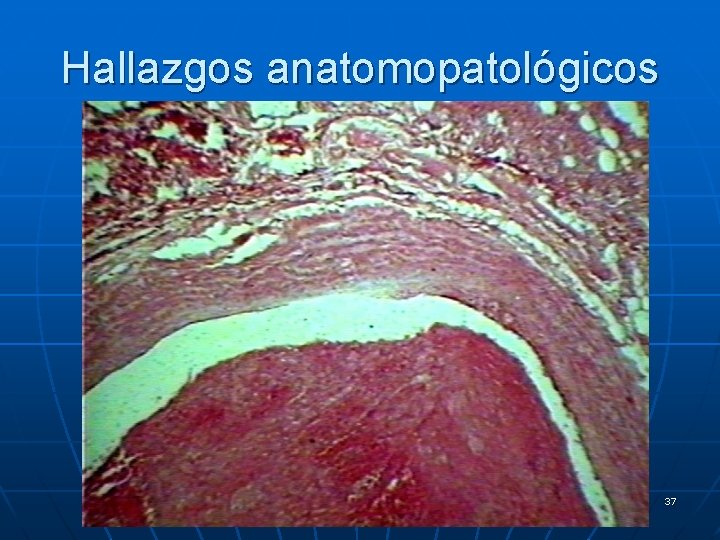 Hallazgos anatomopatológicos 37 