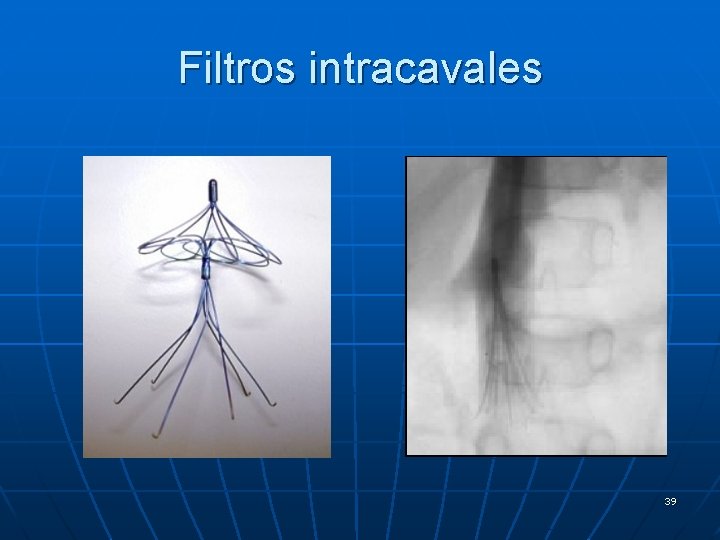 Filtros intracavales 39 