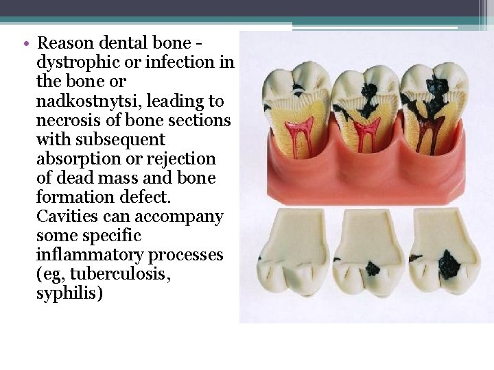  • Reason dental bone dystrophic or infection in the bone or nadkostnytsi, leading
