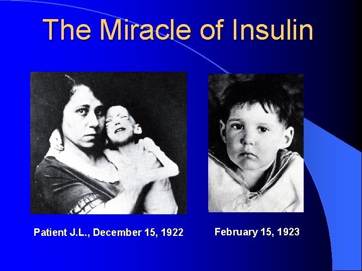 The Miracle of Insulin Patient J. L. , December 15, 1922 February 15, 1923