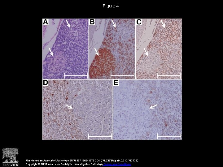 Figure 4 The American Journal of Pathology 2010 1771969 -1976 DOI: (10. 2353/ajpath. 2010.