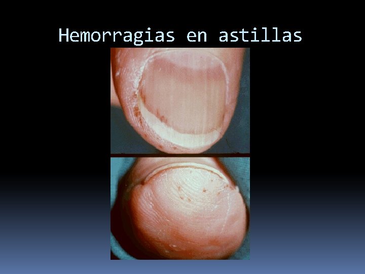 Hemorragias en astillas 