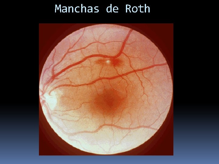 Manchas de Roth 