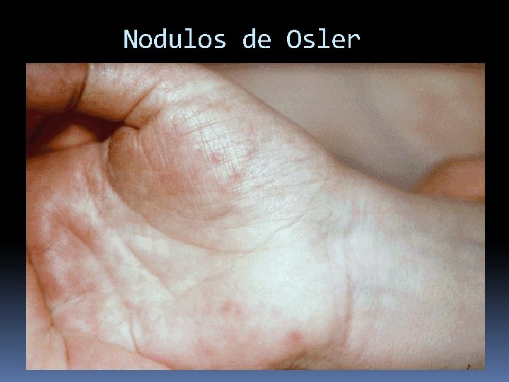Nodulos de Osler 