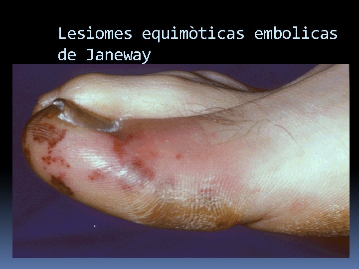 Lesiomes equimòticas embolicas de Janeway 