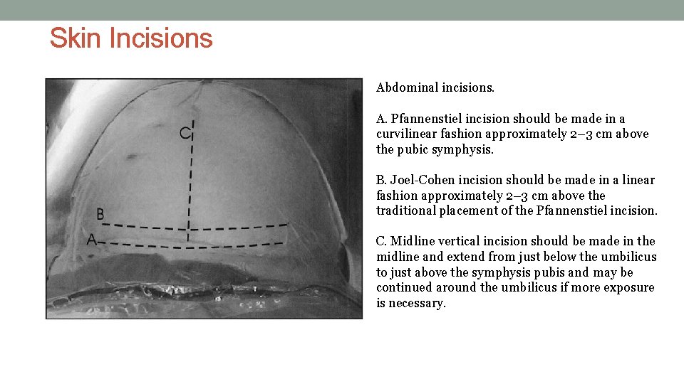 Skin Incisions Abdominal incisions. A. Pfannenstiel incision should be made in a curvilinear fashion