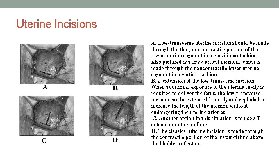 Uterine Incisions A. Low-transverse uterine incision should be made through the thin, noncontractile portion