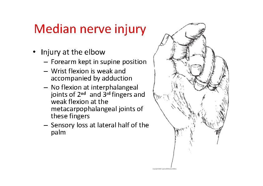 Median nerve injury • Injury at the elbow – Forearm kept in supine position