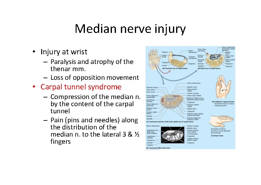 Median nerve injury • Injury at wrist – Paralysis and atrophy of thenar mm.