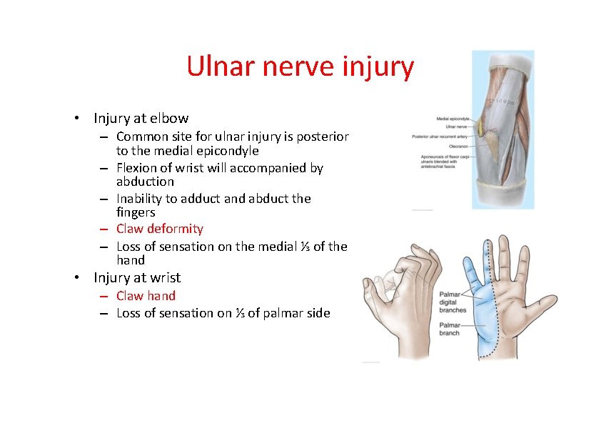 Ulnar nerve injury • Injury at elbow – Common site for ulnar injury is