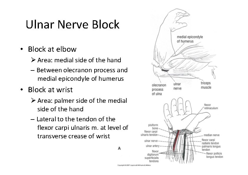 Ulnar Nerve Block • Block at elbow Area: medial side of the hand –